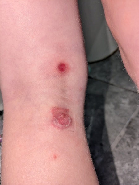 Infected bits getting worse?