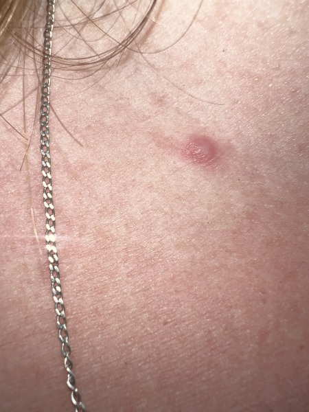 Tick bite - still have a mark 2 months later
