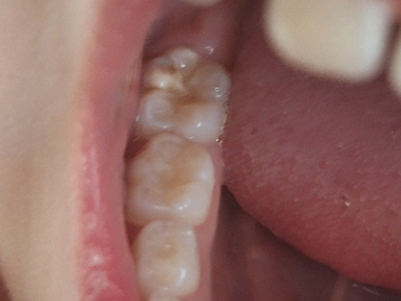How bad is this? Chalky teeth MIH