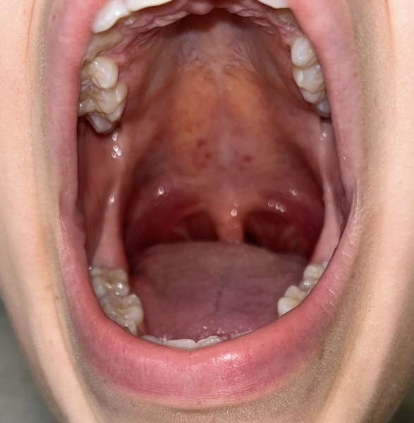 Strep throat? DD is 15