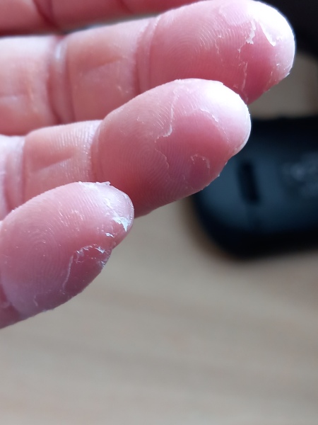 Peeling skin on fingertips - any ideas? Definitely NOT because I don't moisturise ;-)