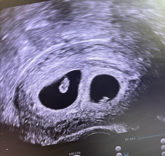 5 week scan with twins