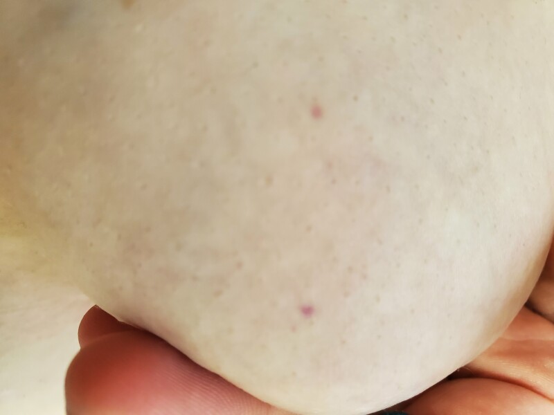 Purple spots on breast