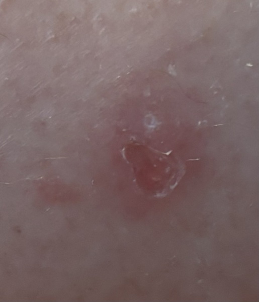 Is this the start of a leg ulcer?