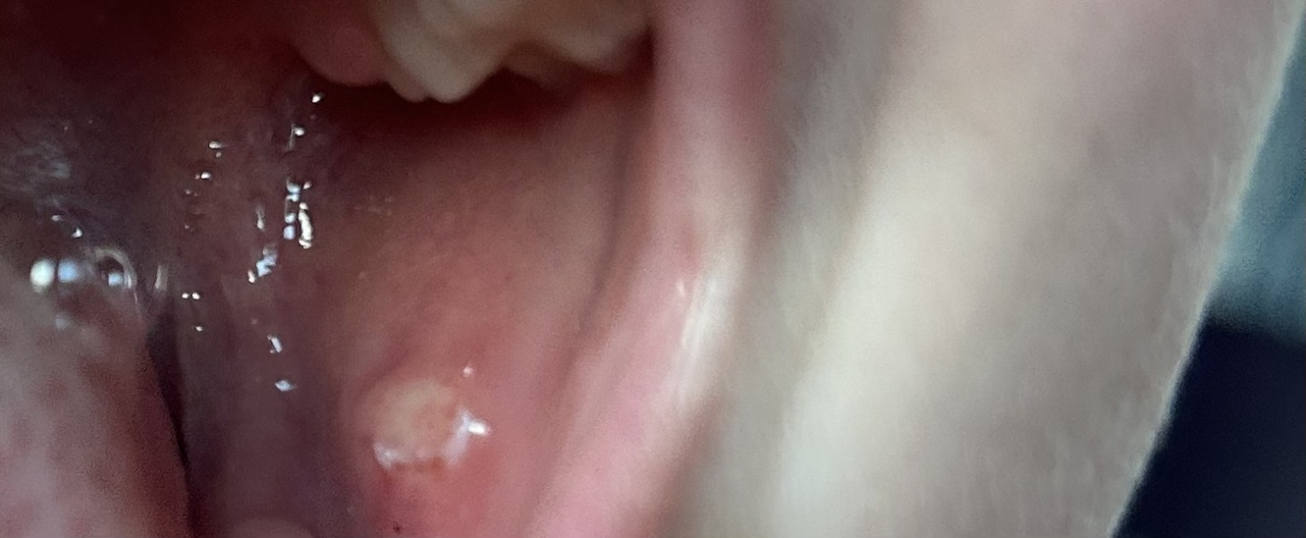 What is this on child’s gum?