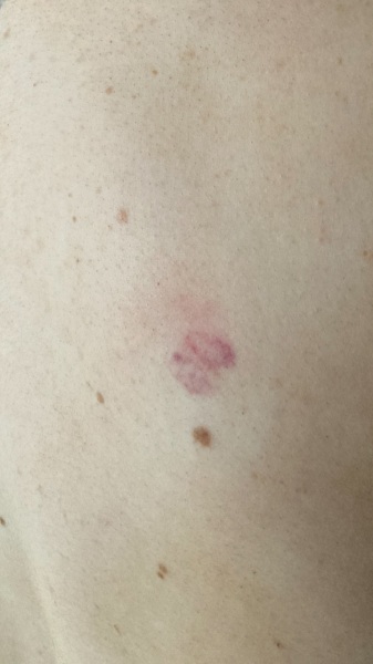 Random bruise/ mark