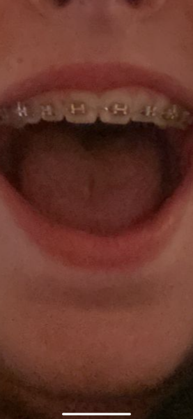 Braces.. results not as good as expected.. help