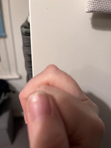 Osteoarthritis in finger joints