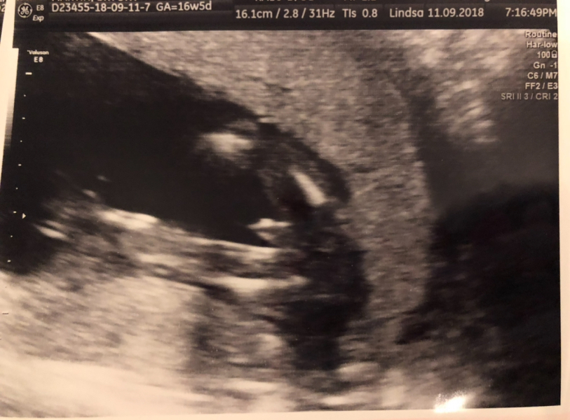 17 week gender scan says boy