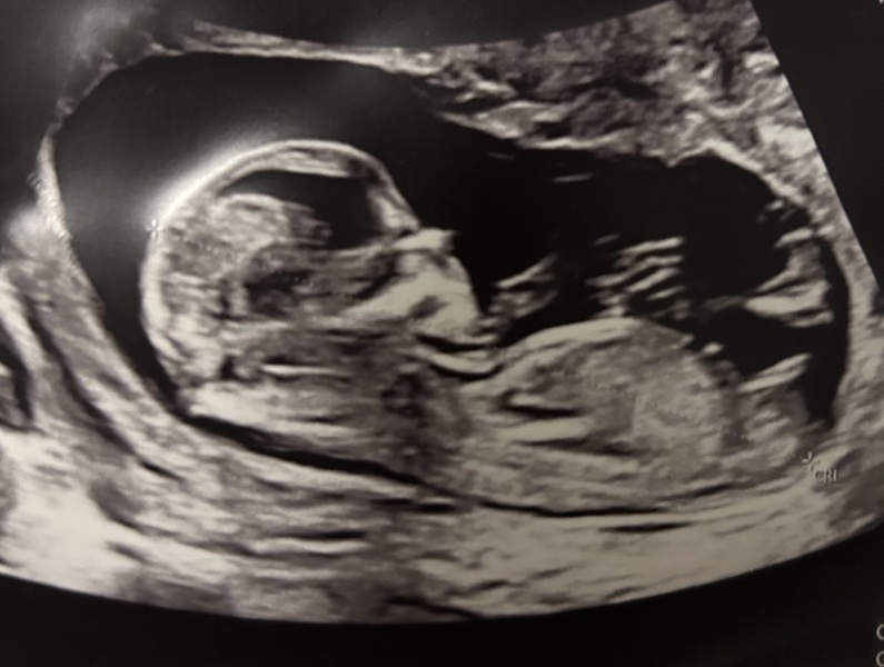Nub theory - boy or girl?