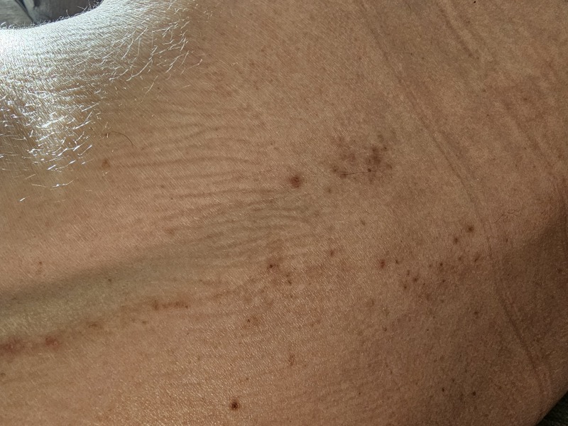 Thyroid dermopathy on back - with pictures