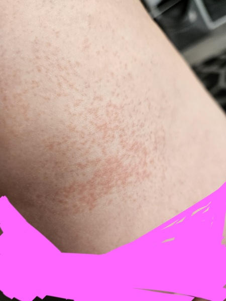 3 year old has a new rash today NO IDEA what it is?