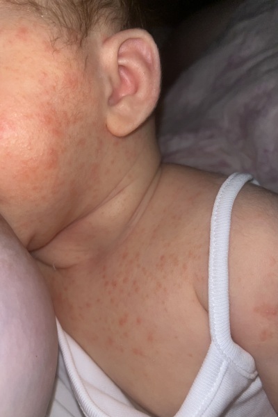 Baby rash