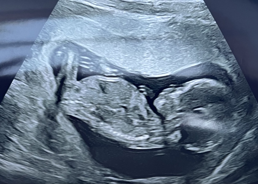 BFP after IVF - the journey continues (part 2)