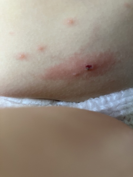 Is thick chicken pox infected?