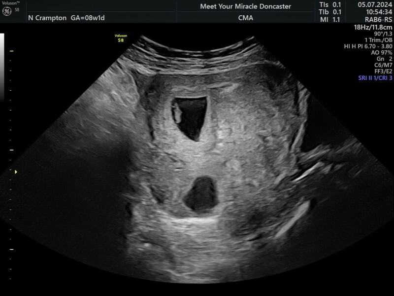 Ovary or second sac?