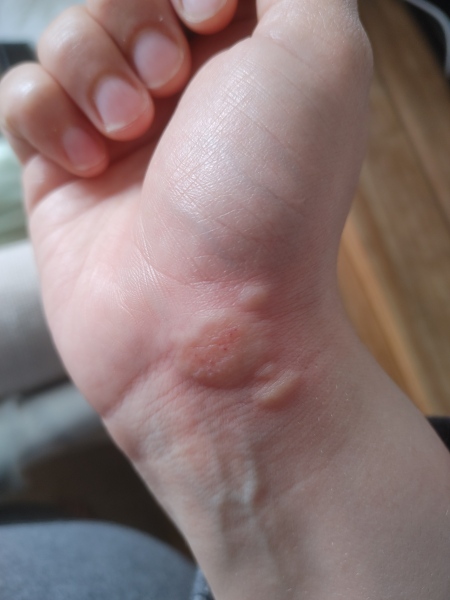 Pregnancy Rash