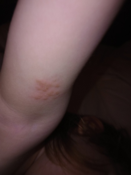 What type of rash/lesion is this?