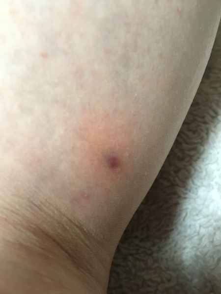 Is this purpura? (Pic included)
