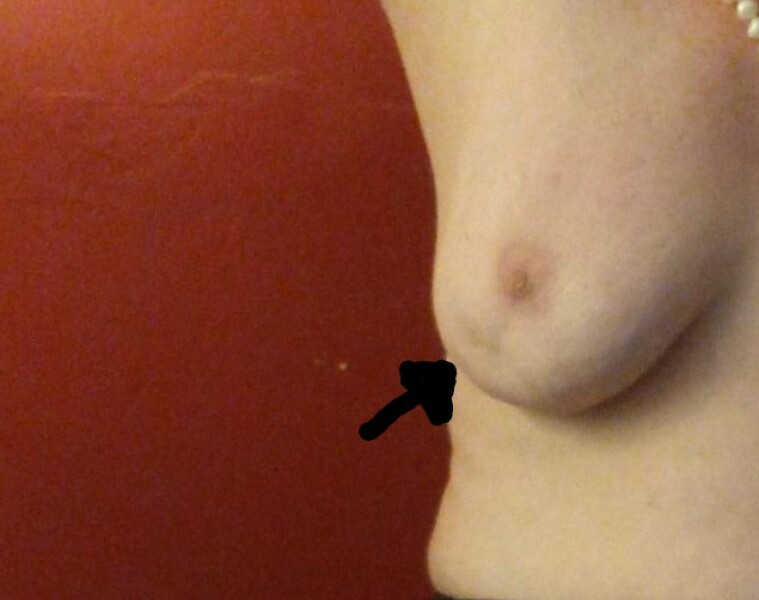 Breast Indent
