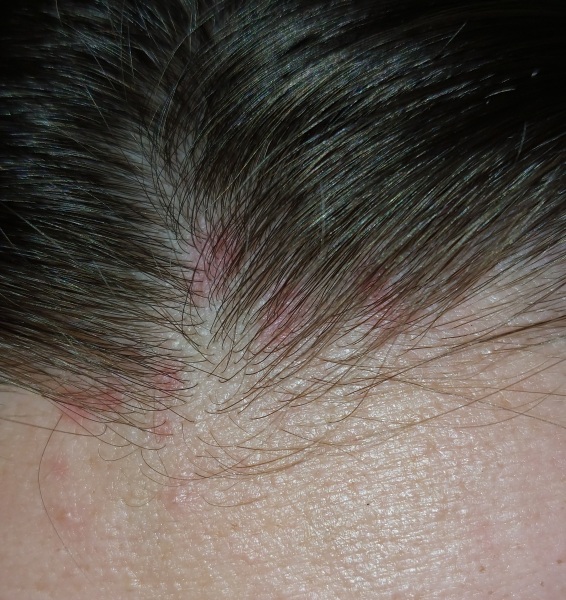 PLEASE HELP! Painful mystery rash on head!