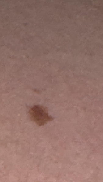 Mole- does this look suspicious?