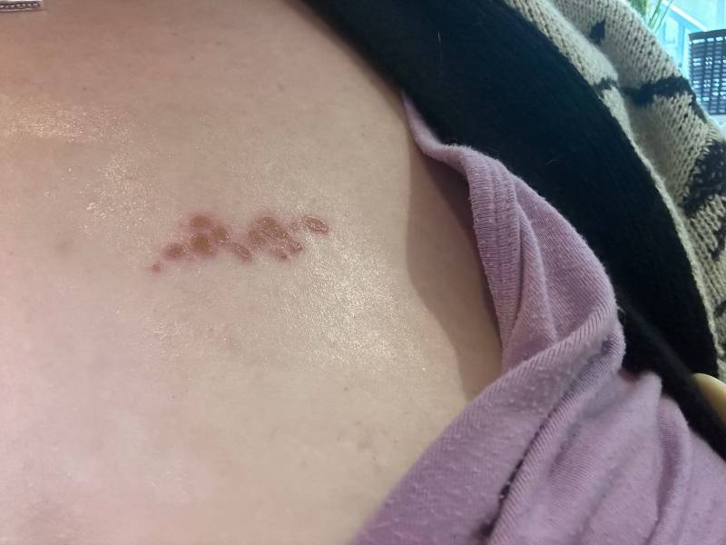 Rash?