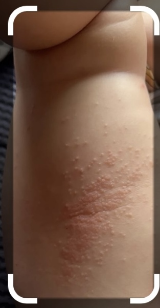 Rash on back of leg