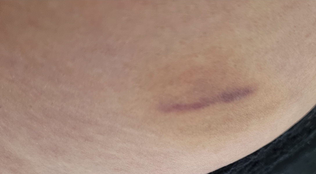 Continuing Mounjaro...part 17