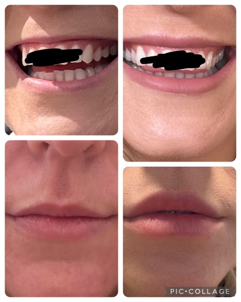 Lip filler