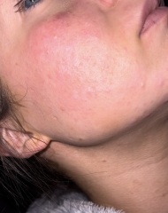 Need help with my hormonal skin at age 29?!