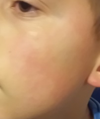 Amoxocillin Rash or Heat rash