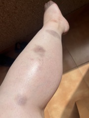 Bruising