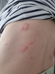 A&E for insect bites?!