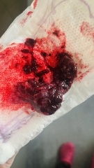 Possible miscarriage? 6 weeks 4 days