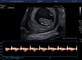 No symptoms/symptom loss in pregnancy