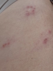A&E for insect bites?!