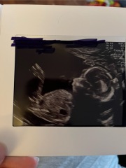 Nub theory 12 and 20 weeks