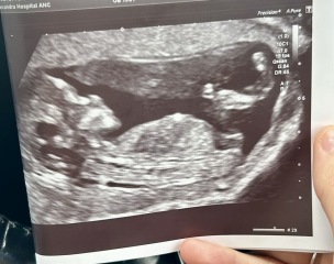 Anyone experienced with looking at ultrasound? Concerns…