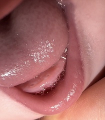 dark spots over teething baby gums