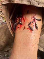 Attacked by Leeches- TMI Photos