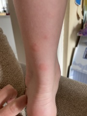 Insect bites