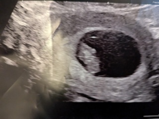 Has anyone seen placenta at 7 weeks pregnant????