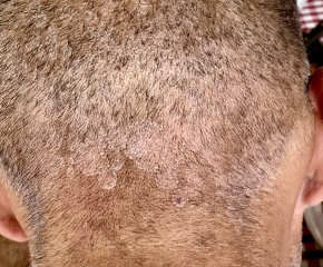 Scalp rash help - ringworm or psoriasis?