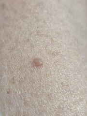 Skin cancer or something else?