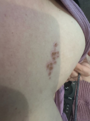 Rash?