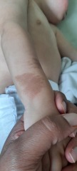 Cafe au lait birthmarks/NF1- who does the diagnosis
