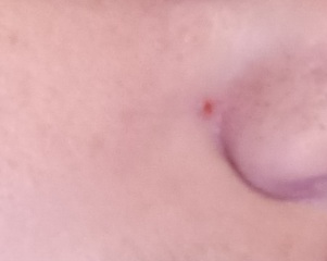 What is this spot that comes up every evening and goes down overnight??  On my face.