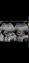 gender girl or boy ultrasound scan