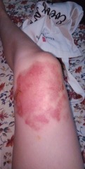 Will this burn leave a scar? Should I use a cream or oil? (Ugly) pic attached